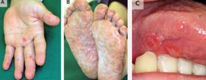 成人也难以幸免的手足口病有什么特征？