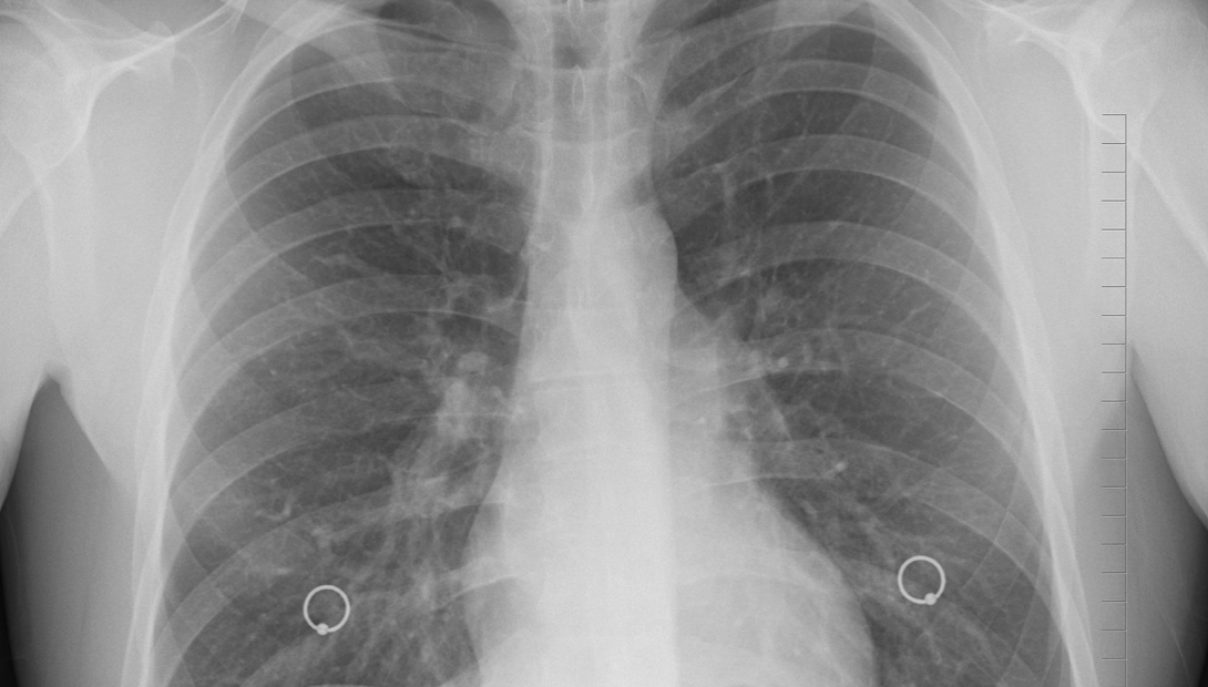 肺癌诊疗中重要的侦察、指示“专家”——ctDNA